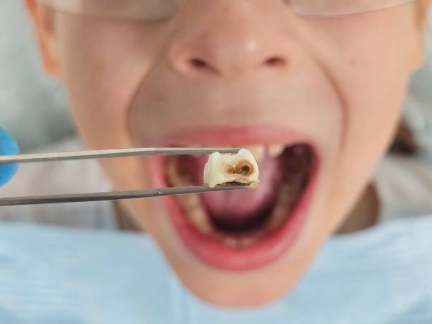 Best Emergency Wisdom Teeth Removal in East Bronson, FL